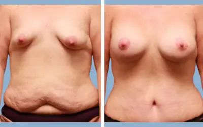 Before and After